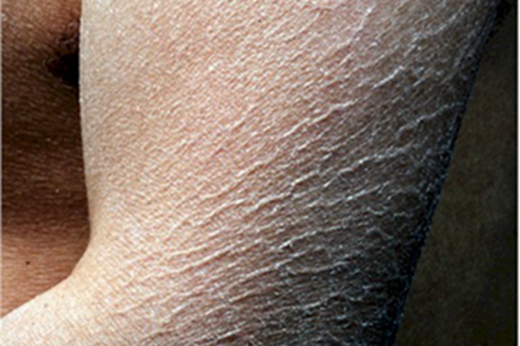 鱼鳞病胳膊纹图