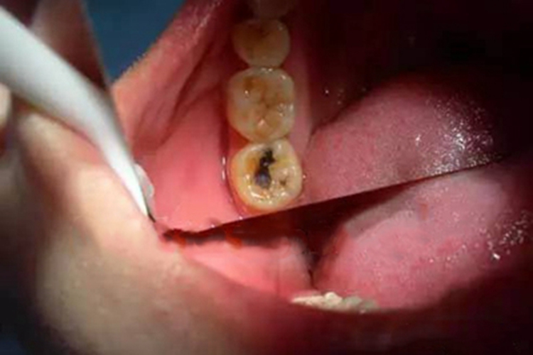 低龄儿童龋牙齿黑洞图