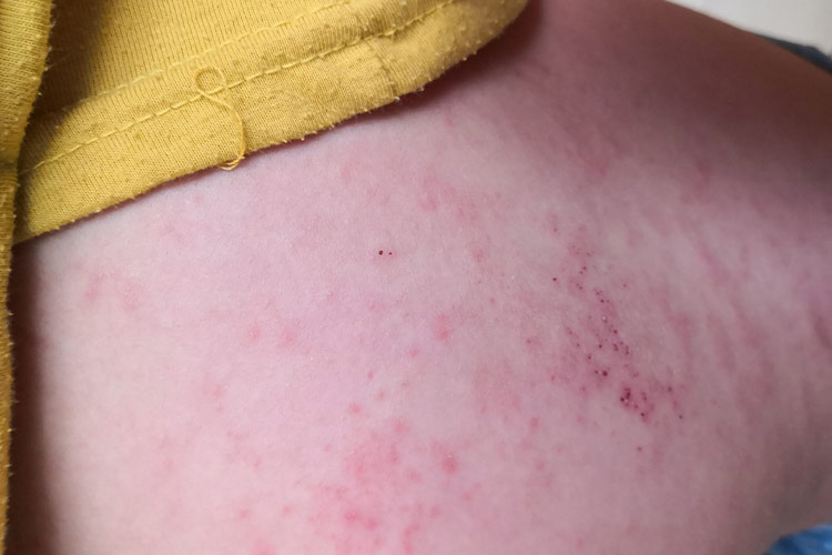 顿挫型带状疱疹图