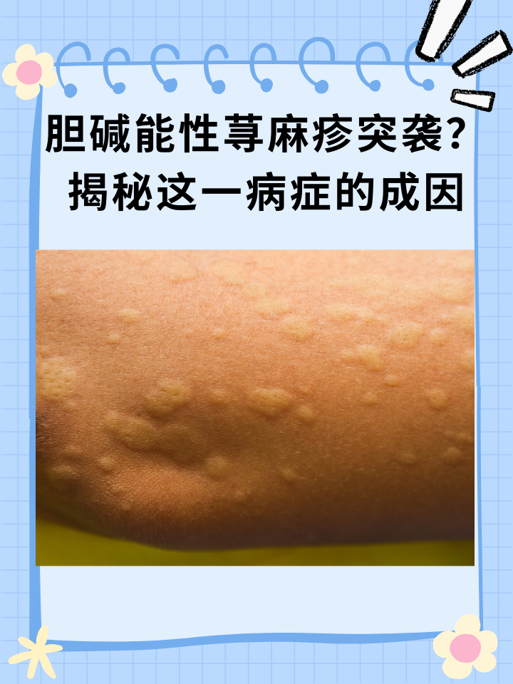 胆碱能性荨麻疹突袭？揭秘这一病症的成因