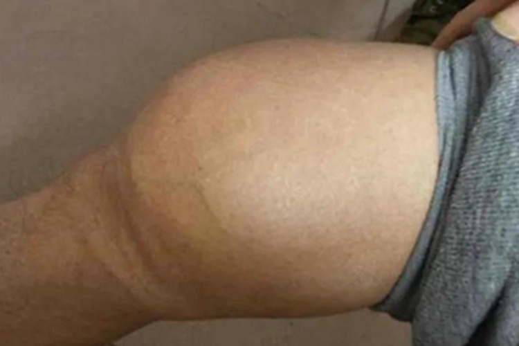 骨肉瘤膝盖肿了一圈图