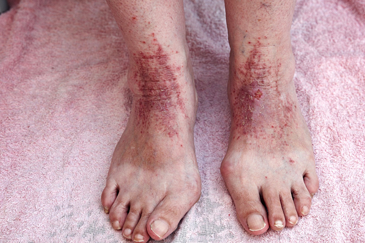 脚部慢性湿疹图 脚部慢性湿疹图