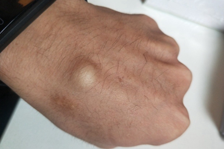 成人型纤维肉瘤手背症状图 成人型纤维肉瘤手背症状图