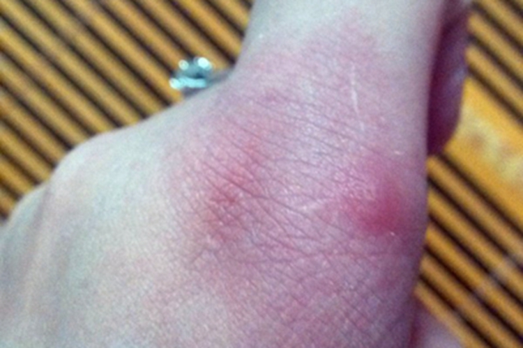 蚁蜇伤手上红斑丘疹图