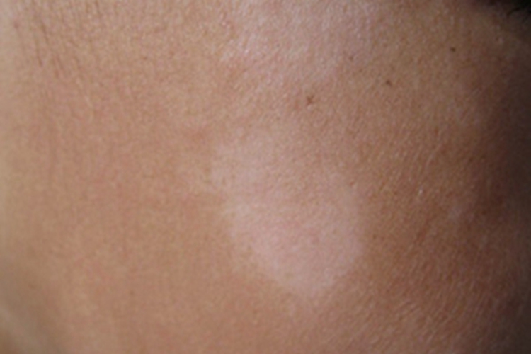 白色糠疹面部长连着的斑图 白色糠疹面部长连着的斑图