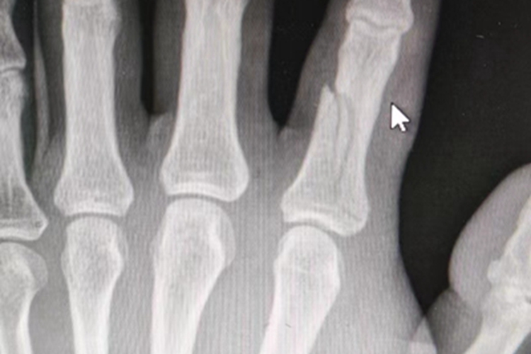 骨折手指裂纹图 骨折手指裂纹图