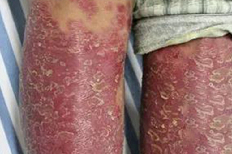 泛发性脓疱型银屑病结痂图 泛发性脓疱型银屑病结痂图