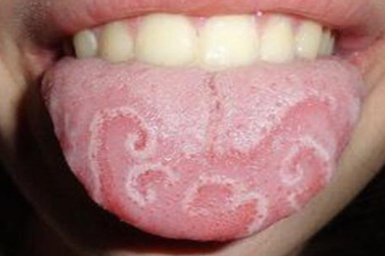 游走性舌炎早期图