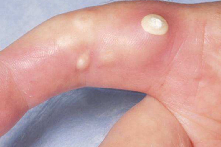 皮肤钙沉着症包块图