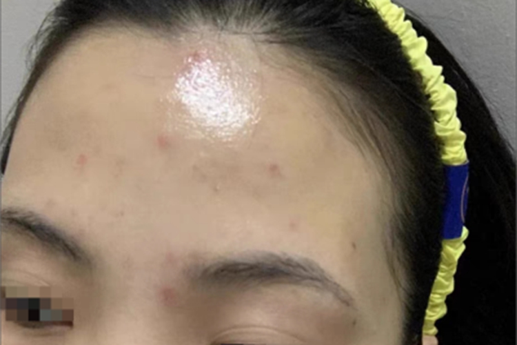 痤疮额头有几个红疙瘩图 痤疮额头有几个红疙瘩图