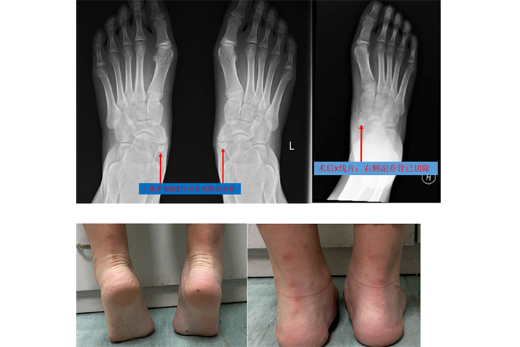 先天性副舟骨手术矫形前后图 先天性副舟骨手术矫形前后图