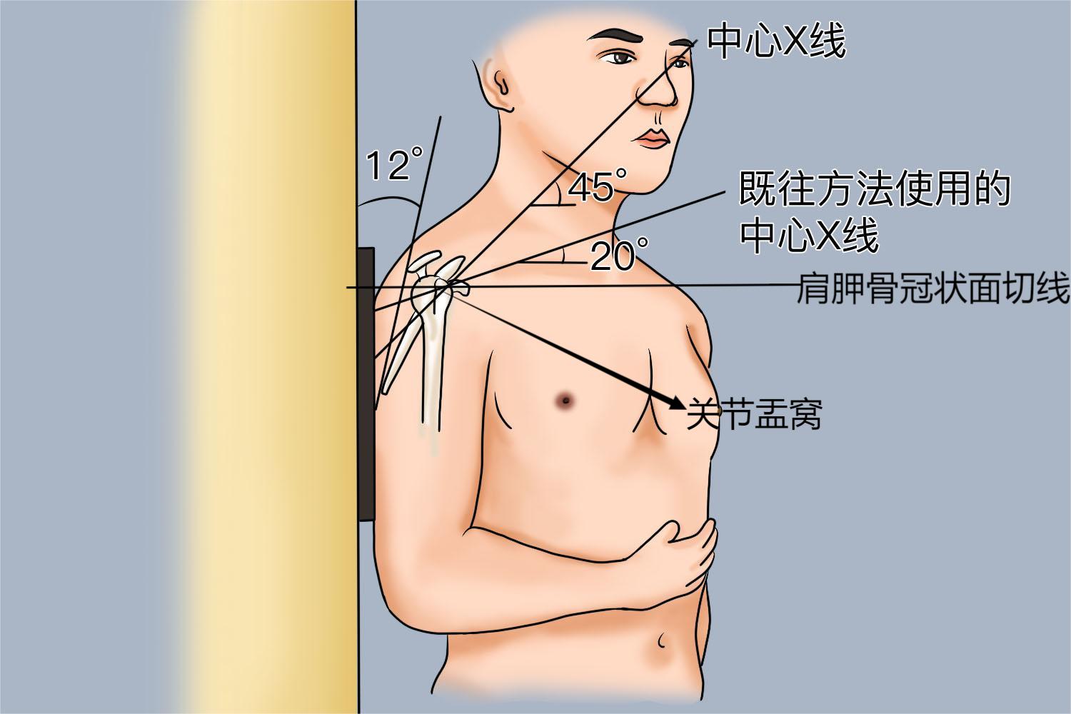 肩胛骨侧位片X线摆位图 肩胛骨侧位片X线摆位图