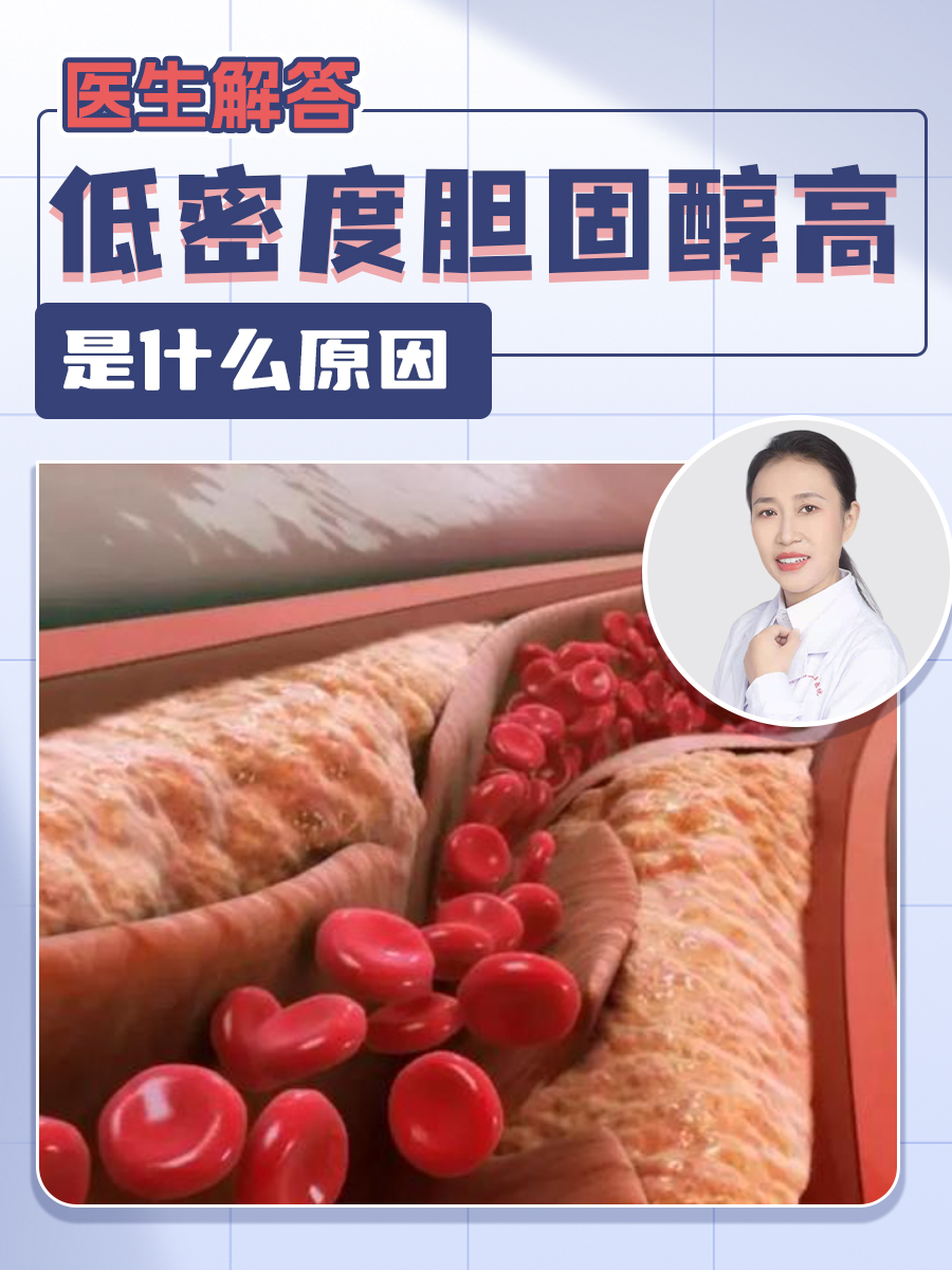 医生解答：低密度胆固醇高是什么原因