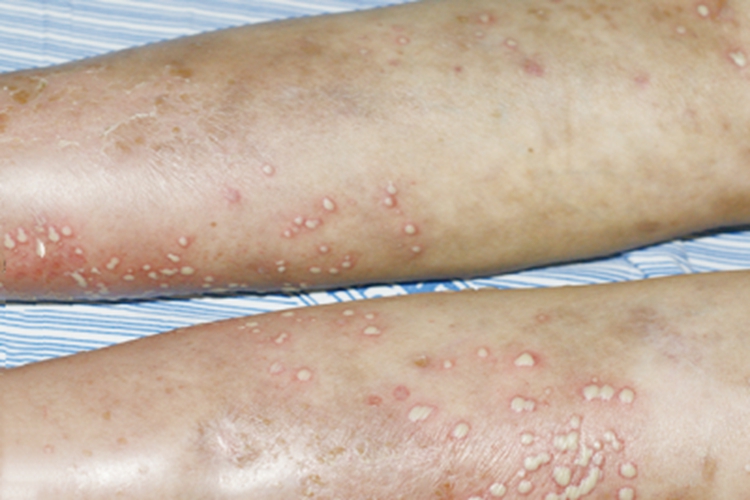角层下脓疱性皮病小腿脓包图