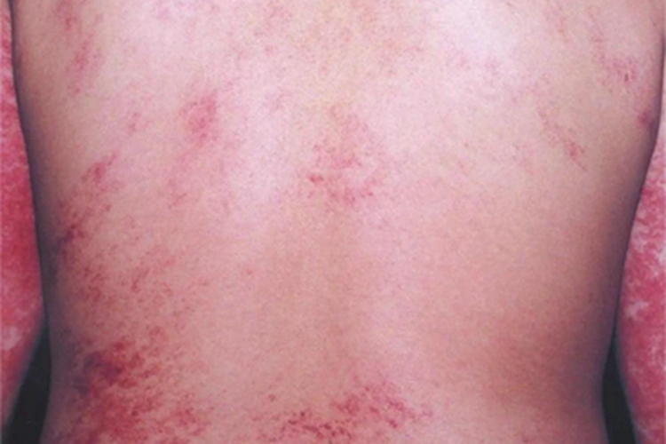 匍行性血管瘤后背有红斑图