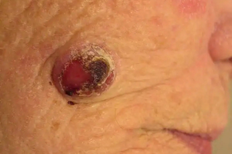 头部鳞状细胞癌面部症状图