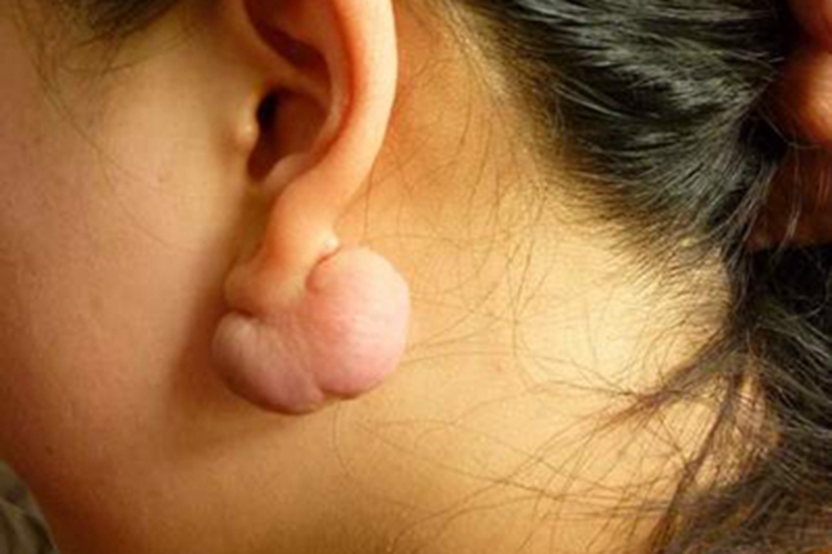 瘢痕疙瘩耳部有凸起的疙瘩图