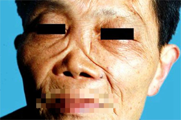 男性梅毒鼻部症状图
