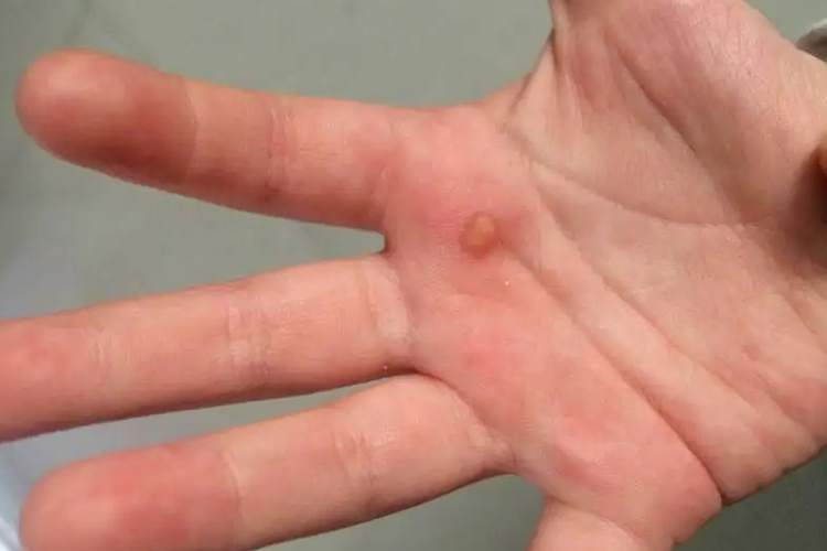 小孩手掌心寻常疣图