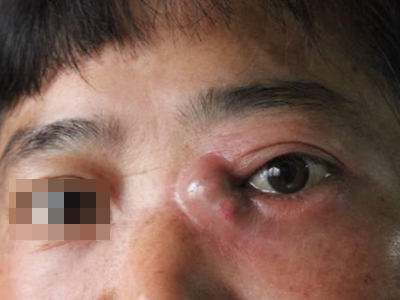 急性泪囊炎左眼内角有个脓包鼓起来了图