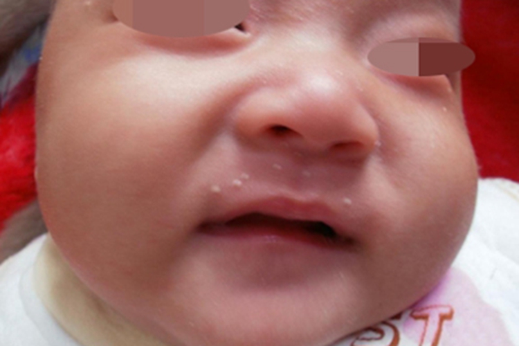 原发性粟丘疹口周丘疹图 原发性粟丘疹口周丘疹图