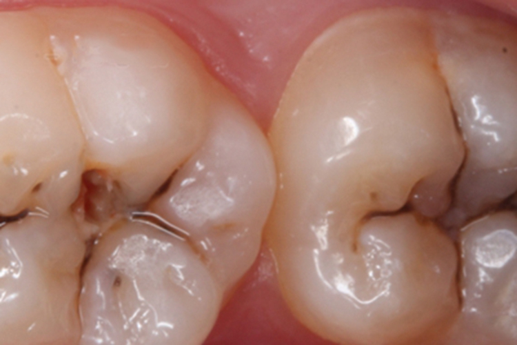 年轻恒牙龋牙齿症状图 年轻恒牙龋牙齿症状图