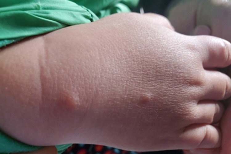 蠓性皮炎手背小疙瘩图