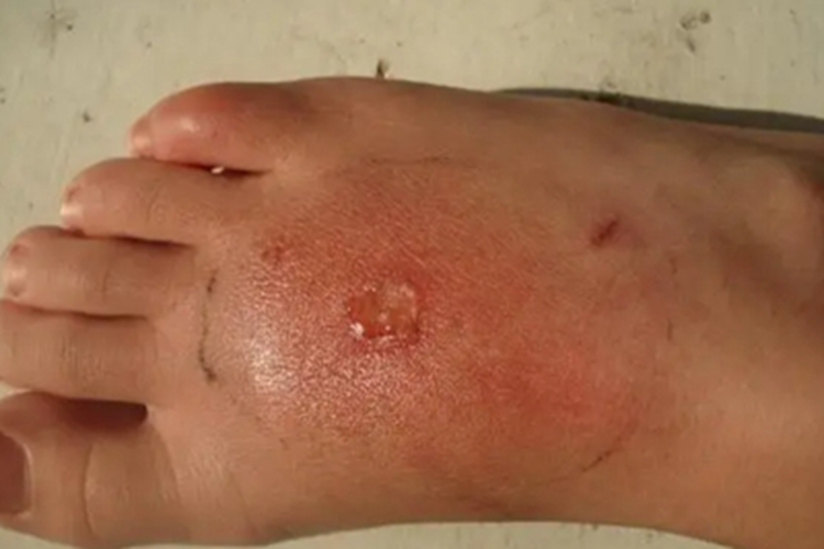 蠓虫叮咬引起的皮肤反应红肿图