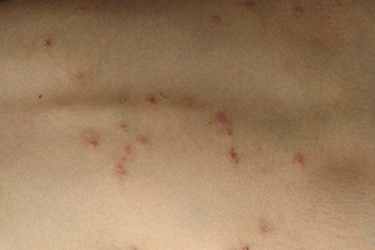 急性单纯性痒疹的图