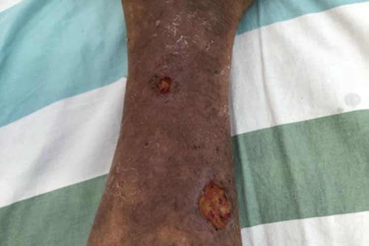 大隐静脉曲张小腿皮肤溃烂图