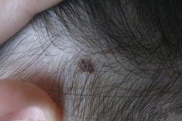 头皮色素痣黑斑图