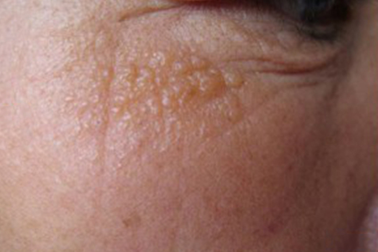 胶样粟丘疹面部症状图