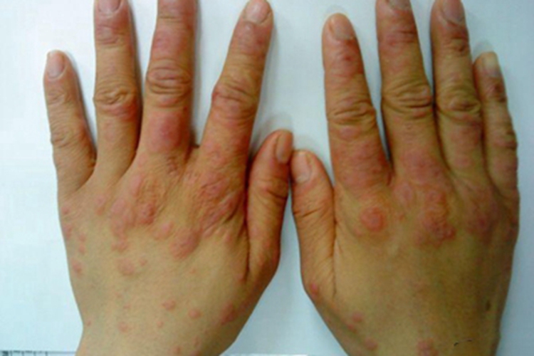 丘疹型轻型多形红斑手背长红斑图
