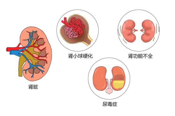 肾脏损害大多数高血压患者都伴有不同程度的肾功能损伤,若血压得不到