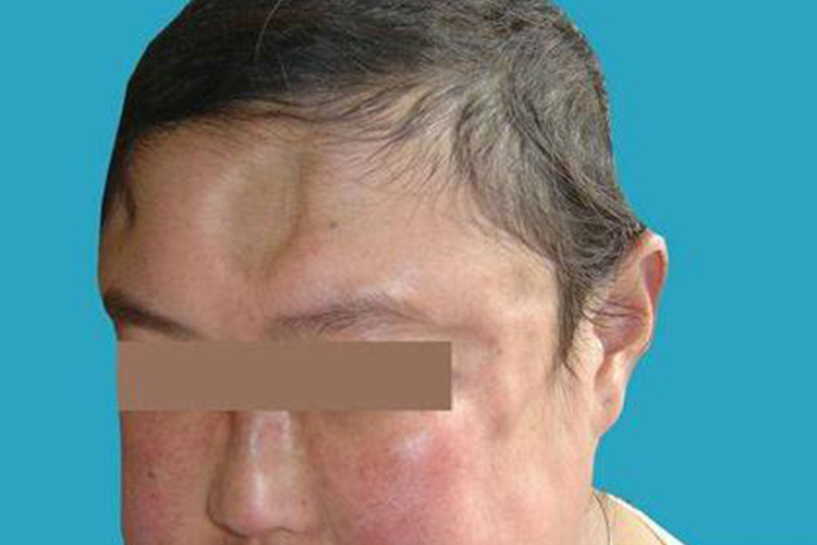 面部深在性红斑狼疮图