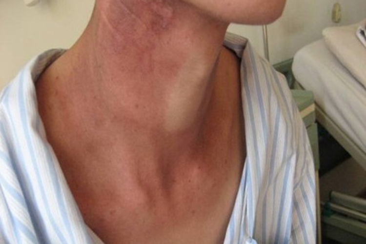 慢性放射性皮炎胸部症状图