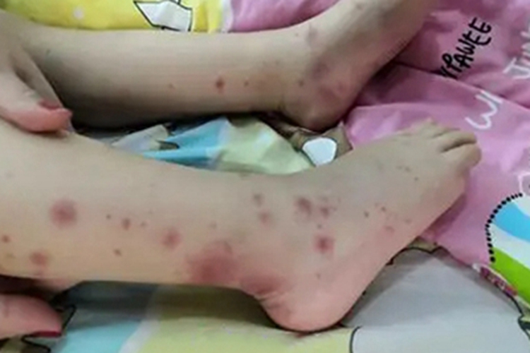 血栓性血小板减少性紫癜红斑图 血栓性血小板减少性紫癜红斑图