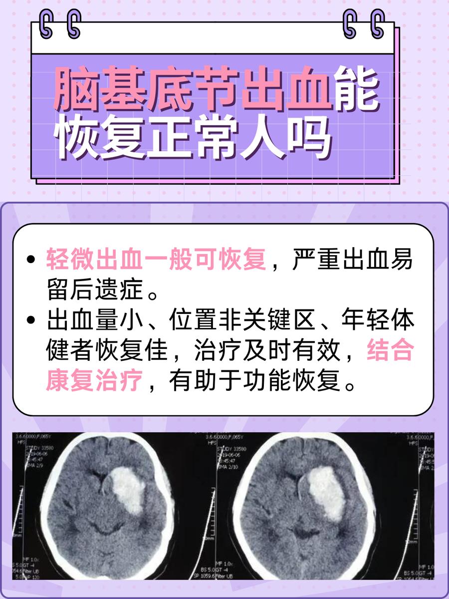 医生揭秘！脑基底节出血能恢复正常人吗