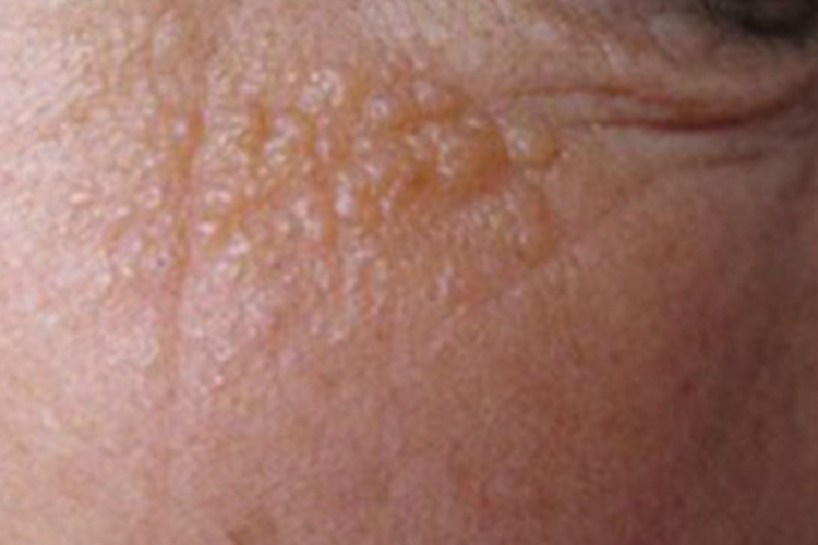 胶样粟丘疹眼周丘疹图