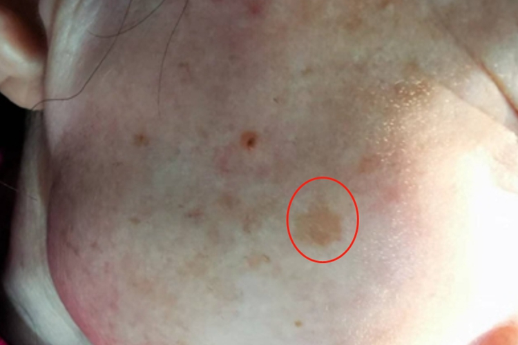 局限型表皮痣面部斑图片