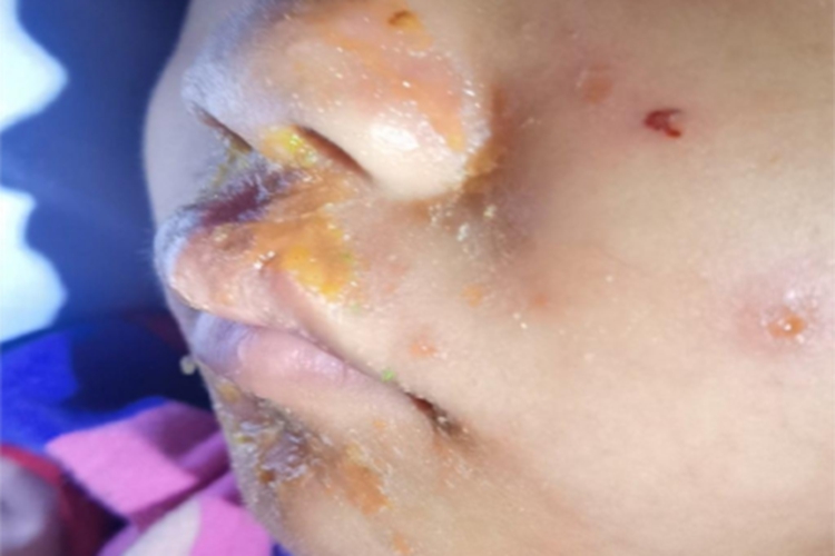 脓疱病口周症状图 脓疱病口周症状图