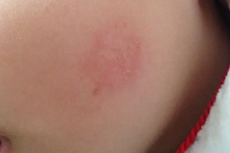 婴儿钱币状湿疹面部红斑图 婴儿钱币状湿疹面部红斑图