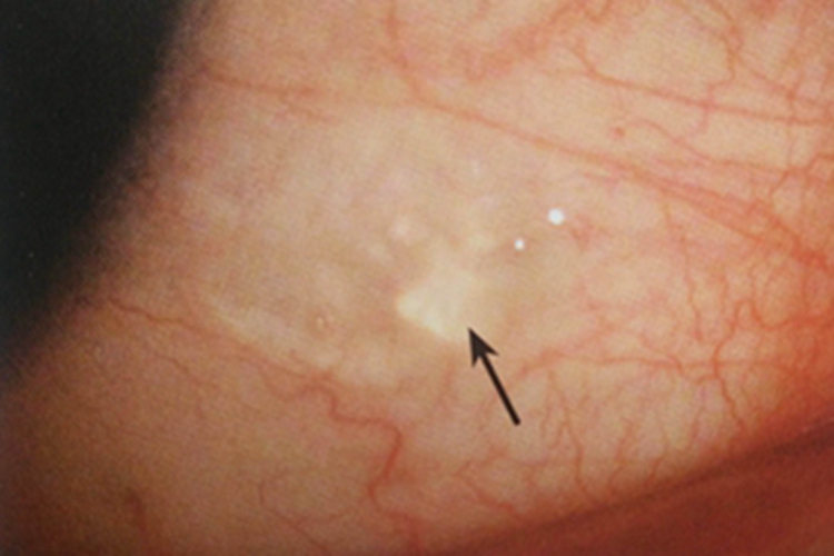 滤泡性结膜炎结膜水疱图 滤泡性结膜炎结膜水疱图