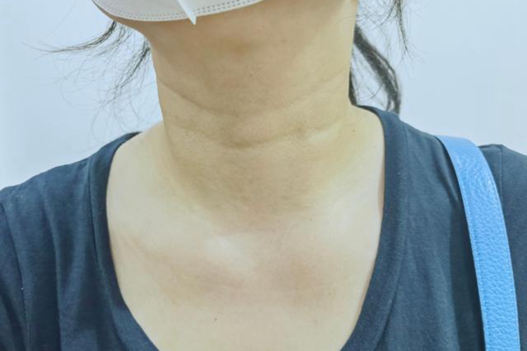 微创辅助术式术后疤痕图