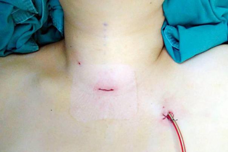 甲状腺腔镜手术锁骨下径路图