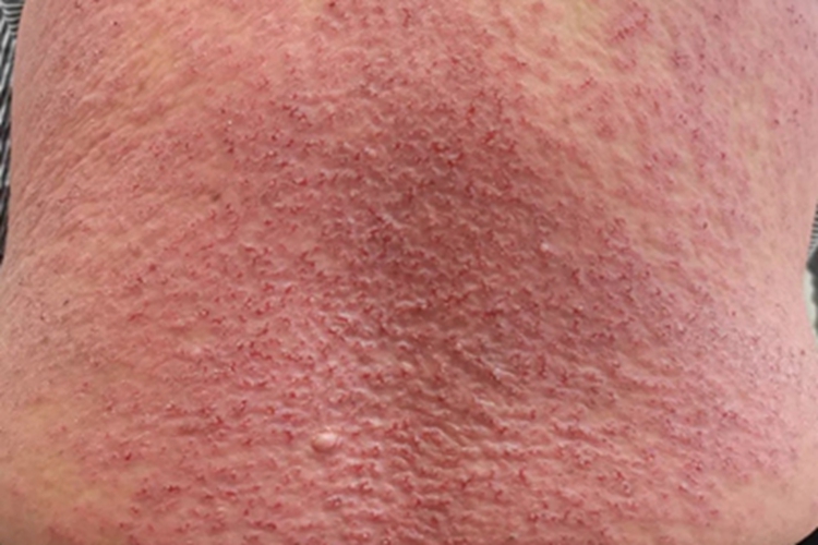 毛囊角化病症状图 毛囊角化病症状图