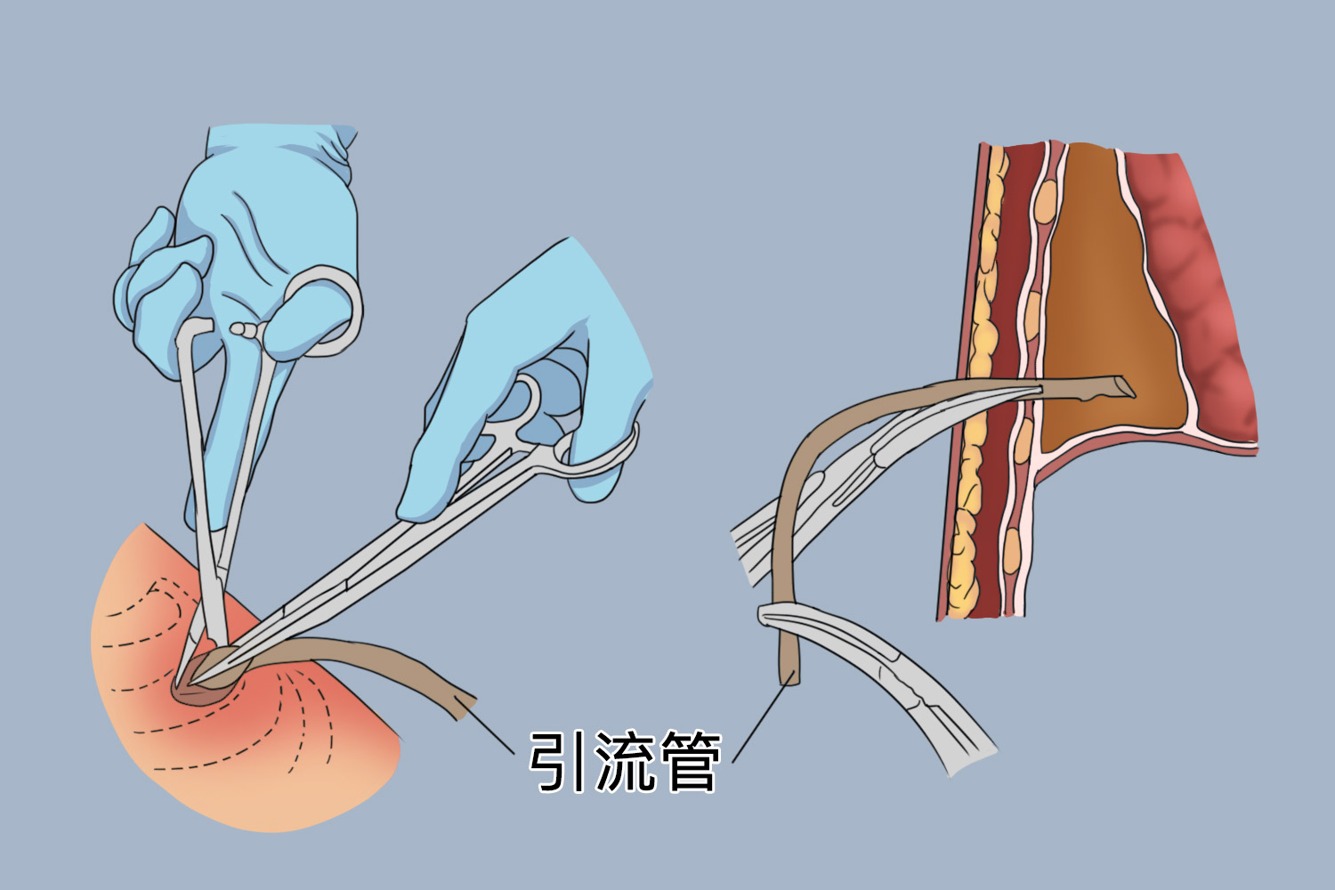 胸腔闭式引流图