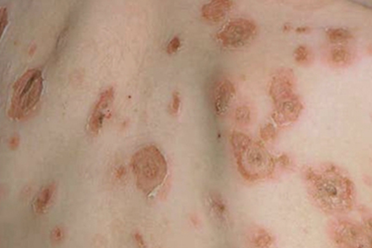 大疱性表皮松解症背部结痂图 大疱性表皮松解症背部结痂图