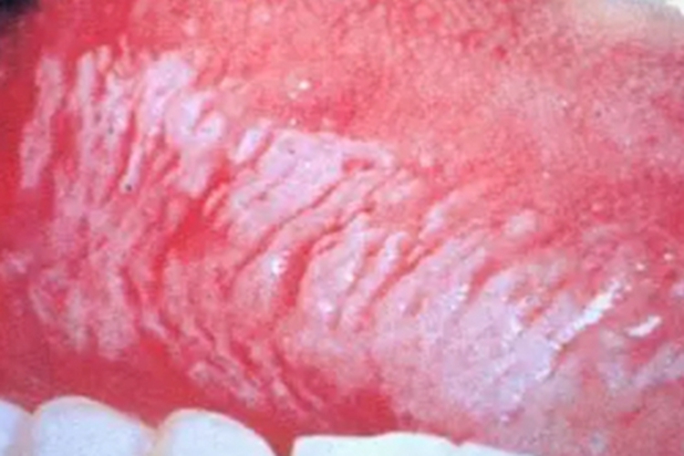 口腔白斑病舌头长条纹白斑图