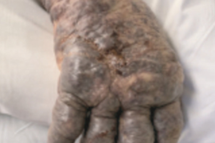 无绿藻病手部水肿图